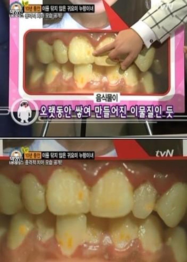 Hàn Quốc: Kỳ lạ cô nàng 10 năm liền không đánh răng 5