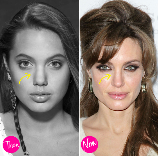Điểm lại những nghi án phẫu thuật thẩm mỹ của Angelina Jolie 3