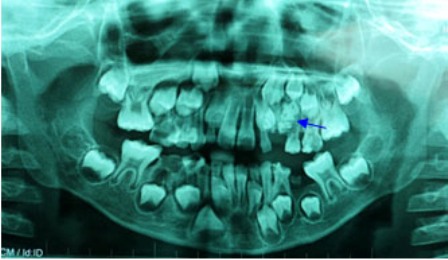 Hình ảnh X-Quang cho thấy túi răng nằm trong miệng bệnh nhi 