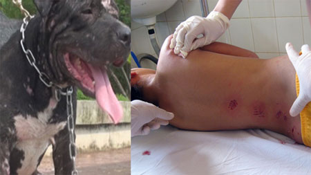 Những vết cắn bị chó tấn công có thể khiến nạn nhân bị nhiễm virus dại, thậm chí tử vong Tấn công đối phương đến chết